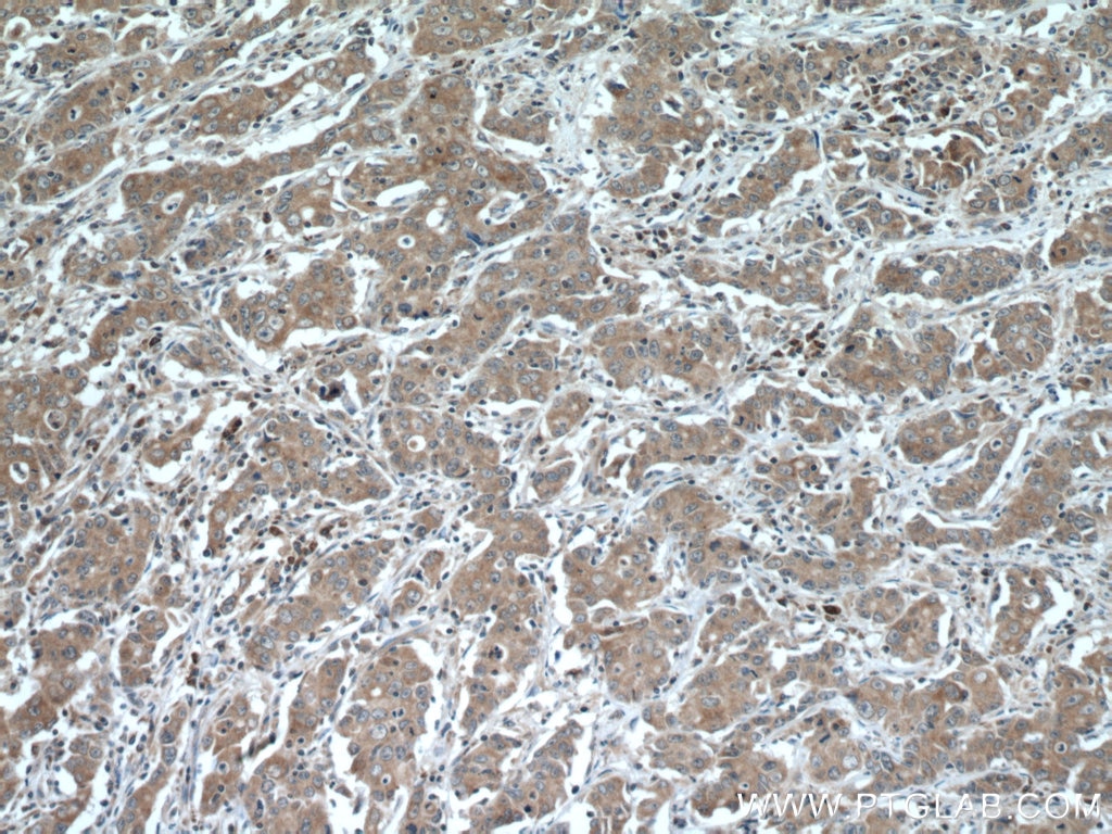 IHC staining of human stomach cancer using 26804-1-AP