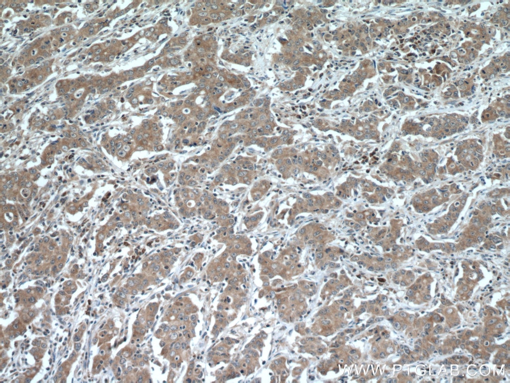 Immunohistochemistry (IHC) staining of human stomach cancer tissue using SLC25A12 Polyclonal antibody (26804-1-AP)