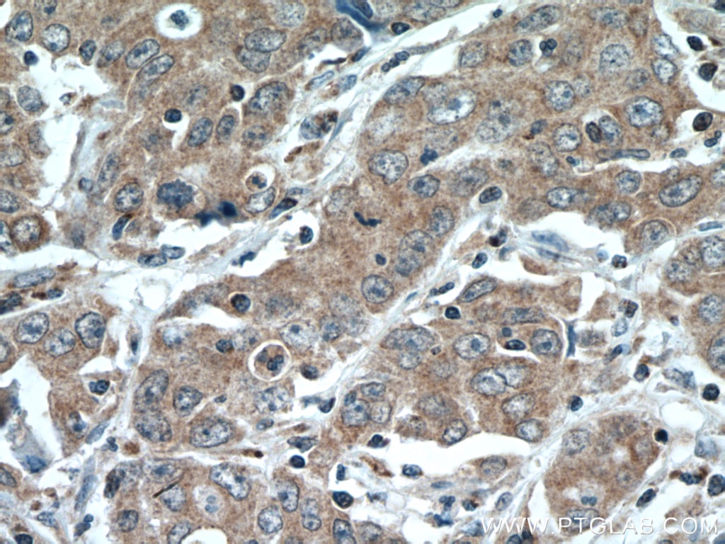 Immunohistochemistry (IHC) staining of human stomach cancer tissue using SLC25A12 Polyclonal antibody (26804-1-AP)