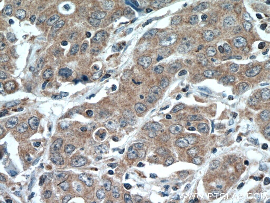 IHC staining of human stomach cancer using 26804-1-AP