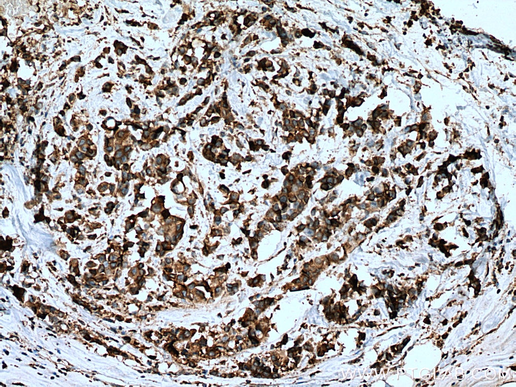 Immunohistochemistry (IHC) staining of human breast cancer tissue using SLC25A12 Monoclonal antibody (67467-1-Ig)