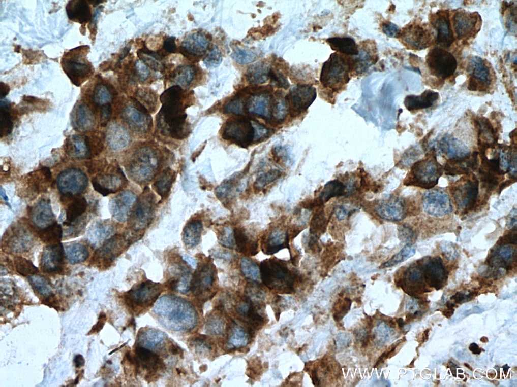 Immunohistochemistry (IHC) staining of human breast cancer tissue using SLC25A12 Monoclonal antibody (67467-1-Ig)