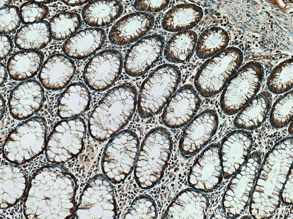 Immunohistochemistry (IHC) staining of human colon cancer tissue using SLC25A13 Polyclonal antibody (10789-1-AP)