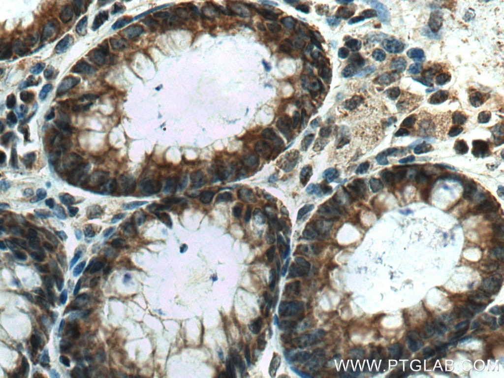 Immunohistochemistry (IHC) staining of human colon cancer tissue using SLC25A13 Polyclonal antibody (10789-1-AP)