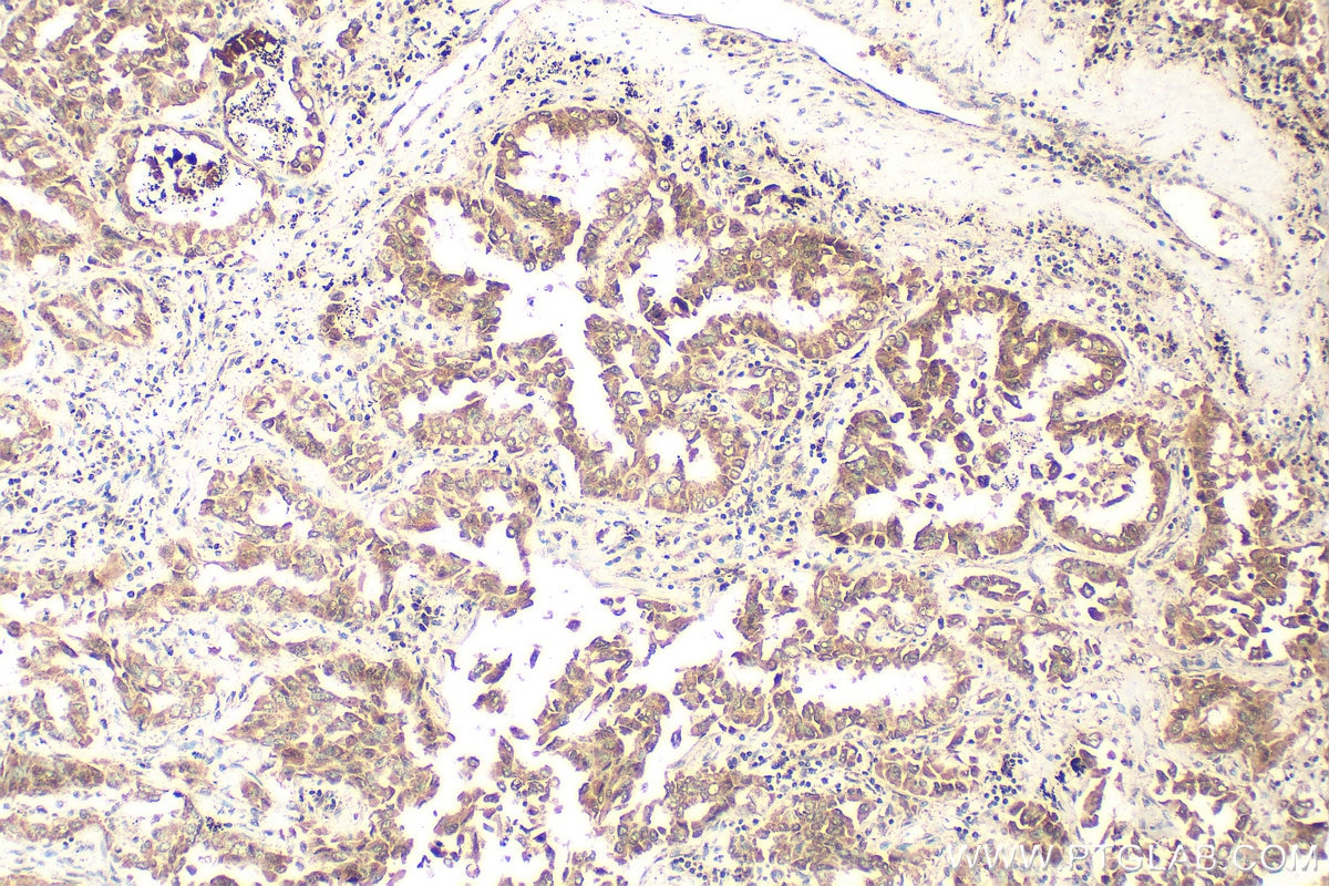 Immunohistochemistry (IHC) staining of human lung cancer tissue using SLC25A13 Polyclonal antibody (10789-1-AP)