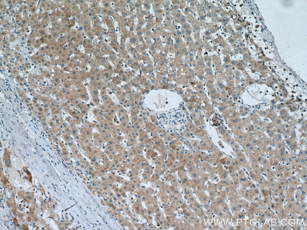 Immunohistochemistry (IHC) staining of human liver cancer tissue using SLC25A15 Polyclonal antibody (15317-1-AP)