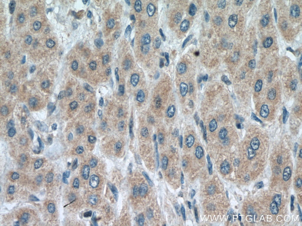 Immunohistochemistry (IHC) staining of human liver cancer tissue using SLC25A15 Polyclonal antibody (15317-1-AP)