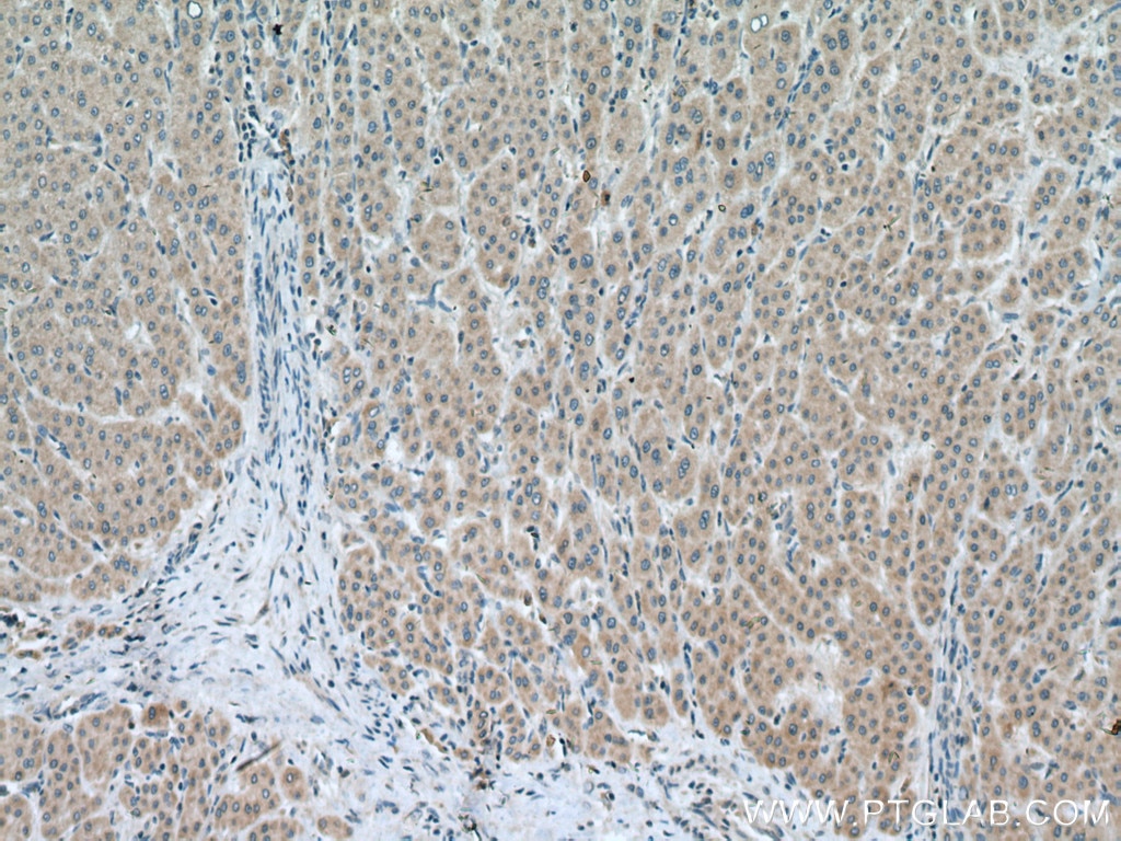 Immunohistochemistry (IHC) staining of human liver cancer tissue using SLC25A15 Polyclonal antibody (15317-1-AP)