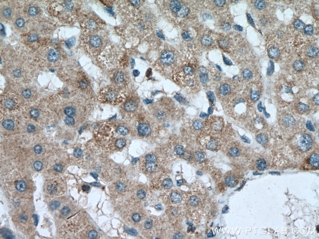 Immunohistochemistry (IHC) staining of human liver cancer tissue using SLC25A15 Polyclonal antibody (15317-1-AP)