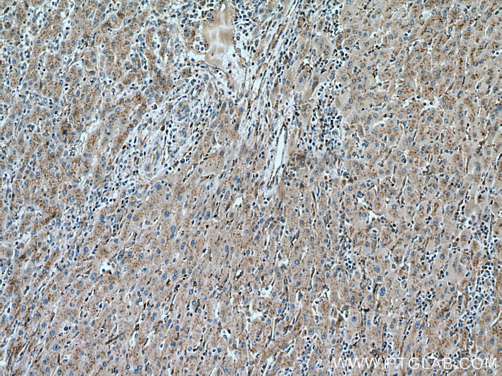 Immunohistochemistry (IHC) staining of human liver cancer tissue using SLC25A17 Monoclonal antibody (67635-1-Ig)