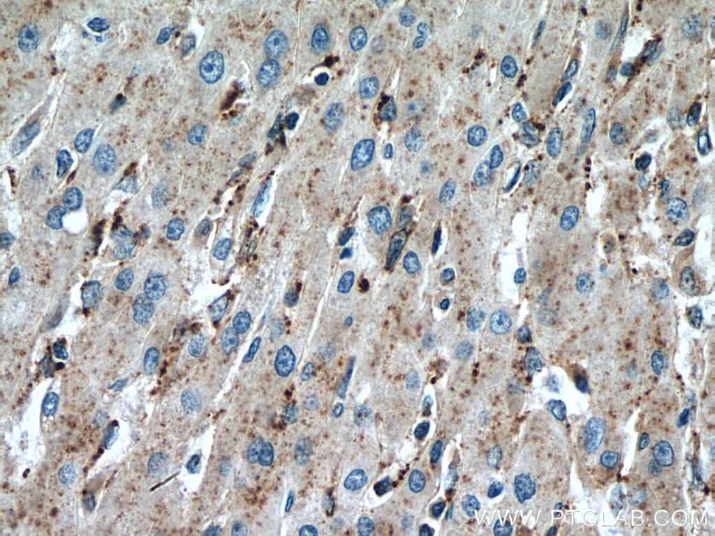 Immunohistochemistry (IHC) staining of human liver cancer tissue using SLC25A17 Monoclonal antibody (67635-1-Ig)