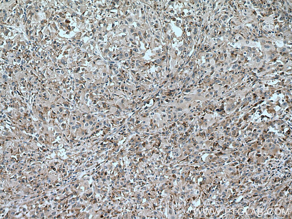IHC staining of human liver cancer using 67635-1-Ig