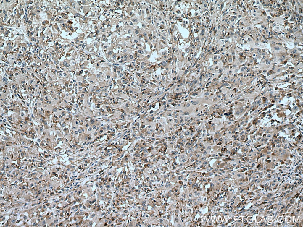 Immunohistochemistry (IHC) staining of human liver cancer tissue using SLC25A17 Monoclonal antibody (67635-1-Ig)