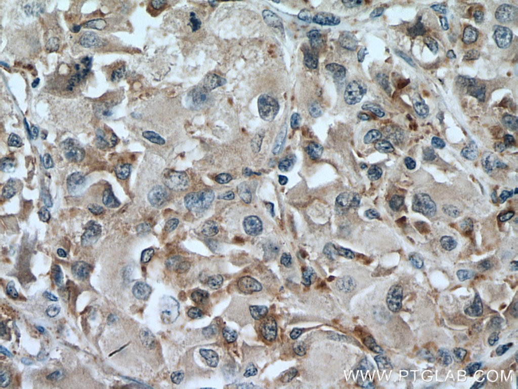 Immunohistochemistry (IHC) staining of human liver cancer tissue using SLC25A17 Monoclonal antibody (67635-1-Ig)