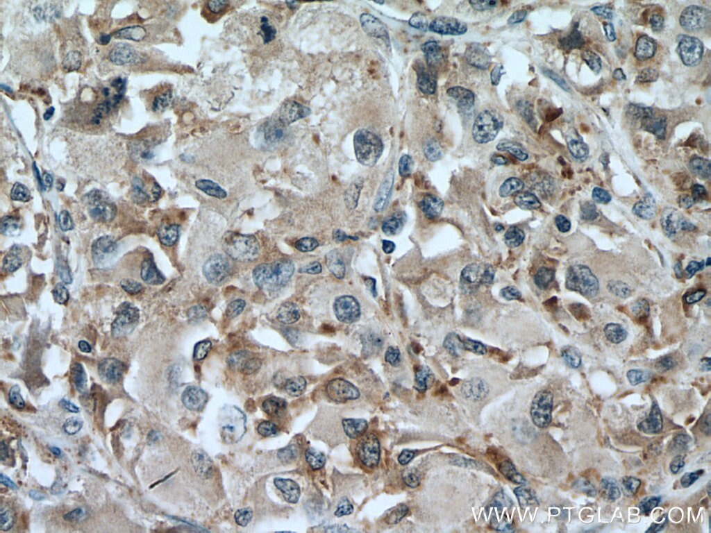 IHC staining of human liver cancer using 67635-1-Ig