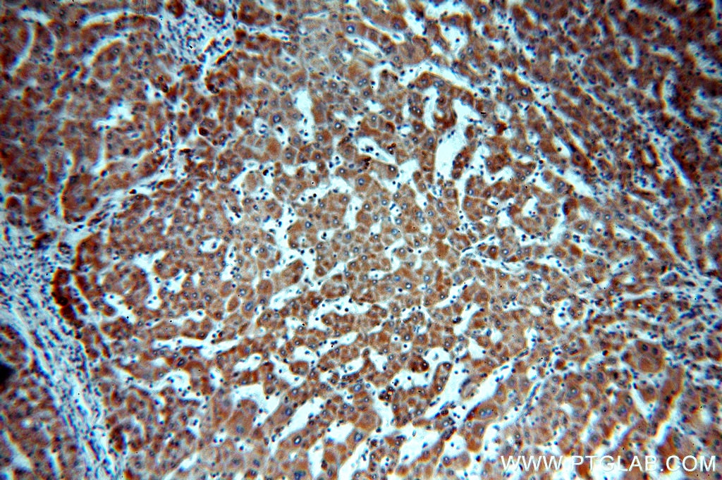 Immunohistochemistry (IHC) staining of human hepatocirrhosis tissue using SLC25A20 Polyclonal antibody (19363-1-AP)