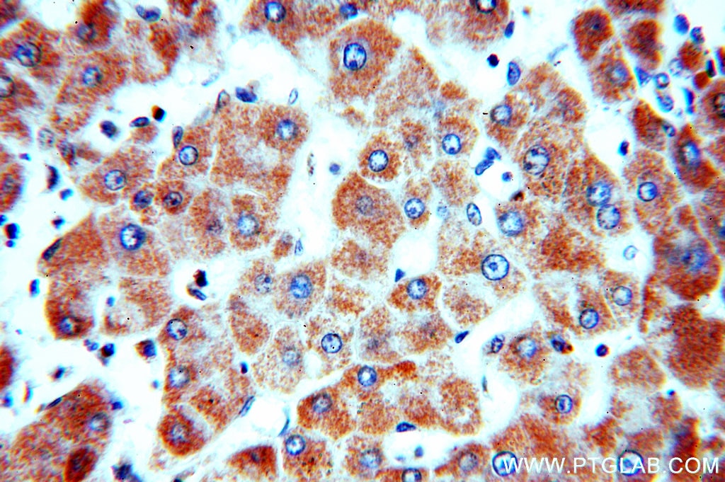 Immunohistochemistry (IHC) staining of human hepatocirrhosis tissue using SLC25A20 Polyclonal antibody (19363-1-AP)