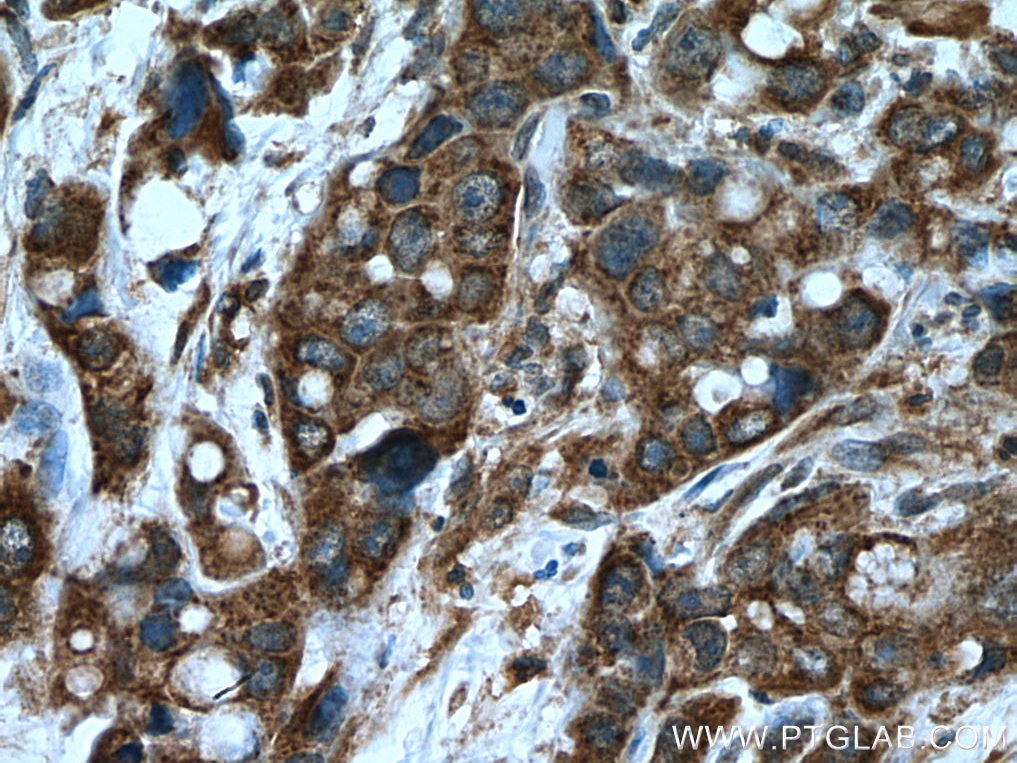 Immunohistochemistry (IHC) staining of human liver cancer tissue using SLC25A22 Polyclonal antibody (25402-1-AP)