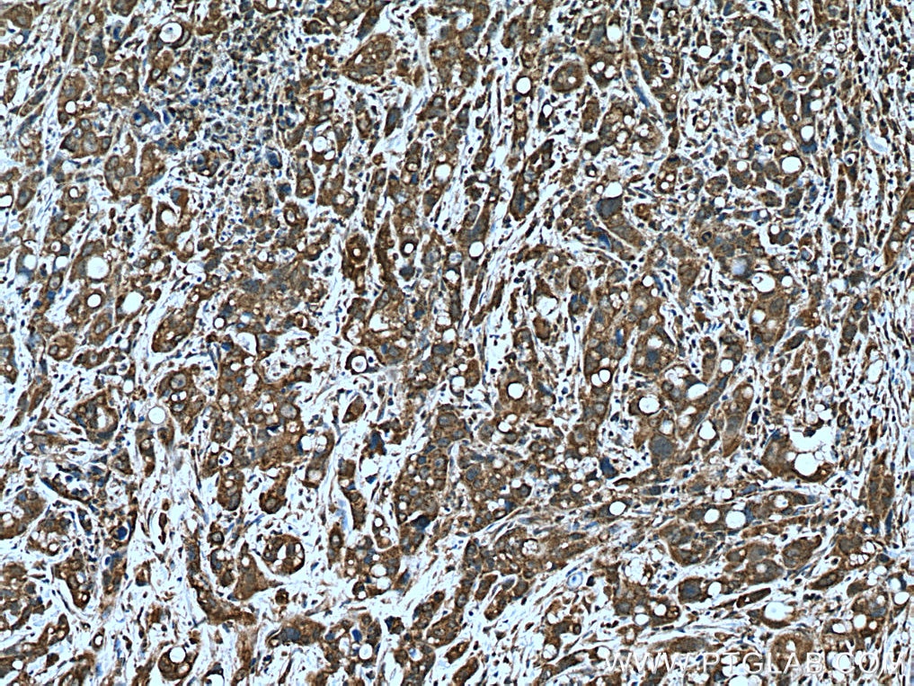 Immunohistochemistry (IHC) staining of human liver cancer tissue using SLC25A22 Polyclonal antibody (25402-1-AP)