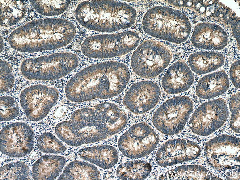 Immunohistochemistry (IHC) staining of human colon cancer tissue using SLC25A22 Polyclonal antibody (25402-1-AP)