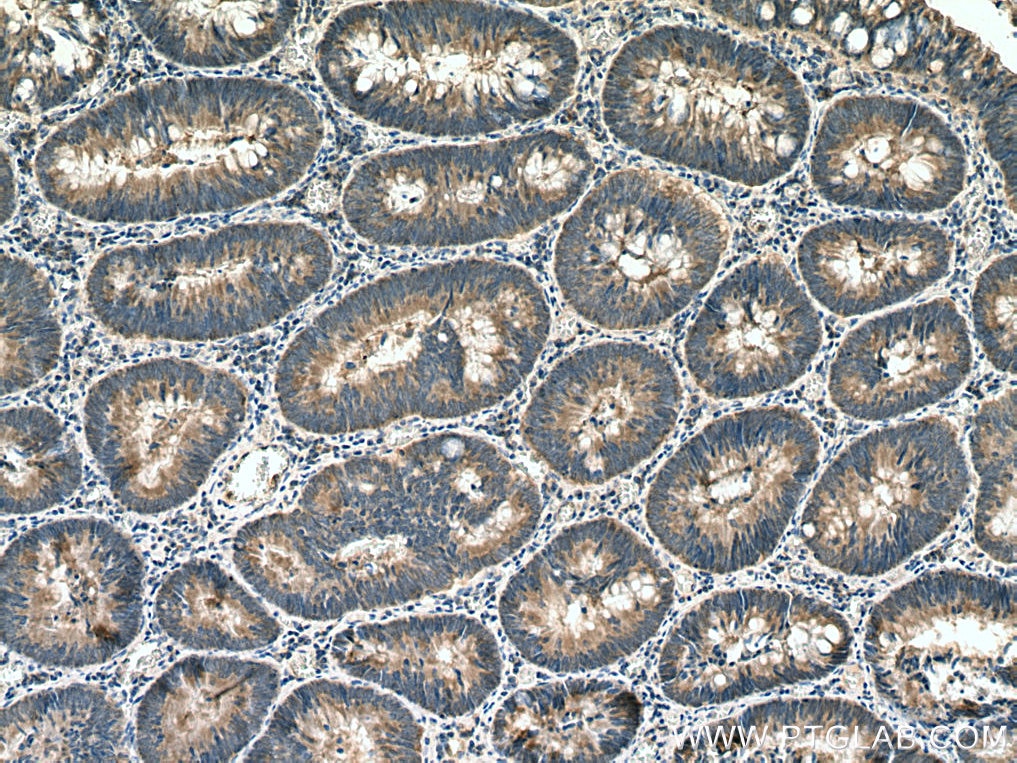 Immunohistochemistry (IHC) staining of human colon cancer tissue using SLC25A22 Polyclonal antibody (25402-1-AP)