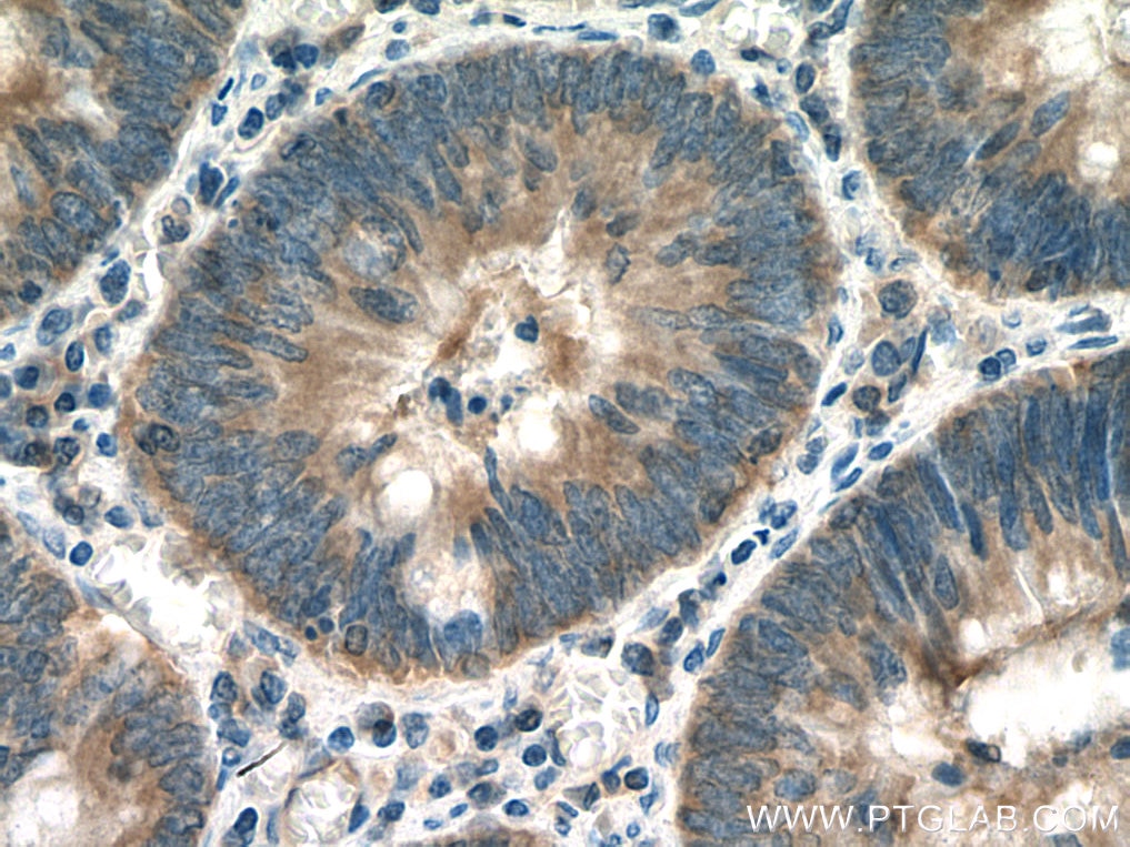 Immunohistochemistry (IHC) staining of human colon cancer tissue using SLC25A22 Polyclonal antibody (25402-1-AP)