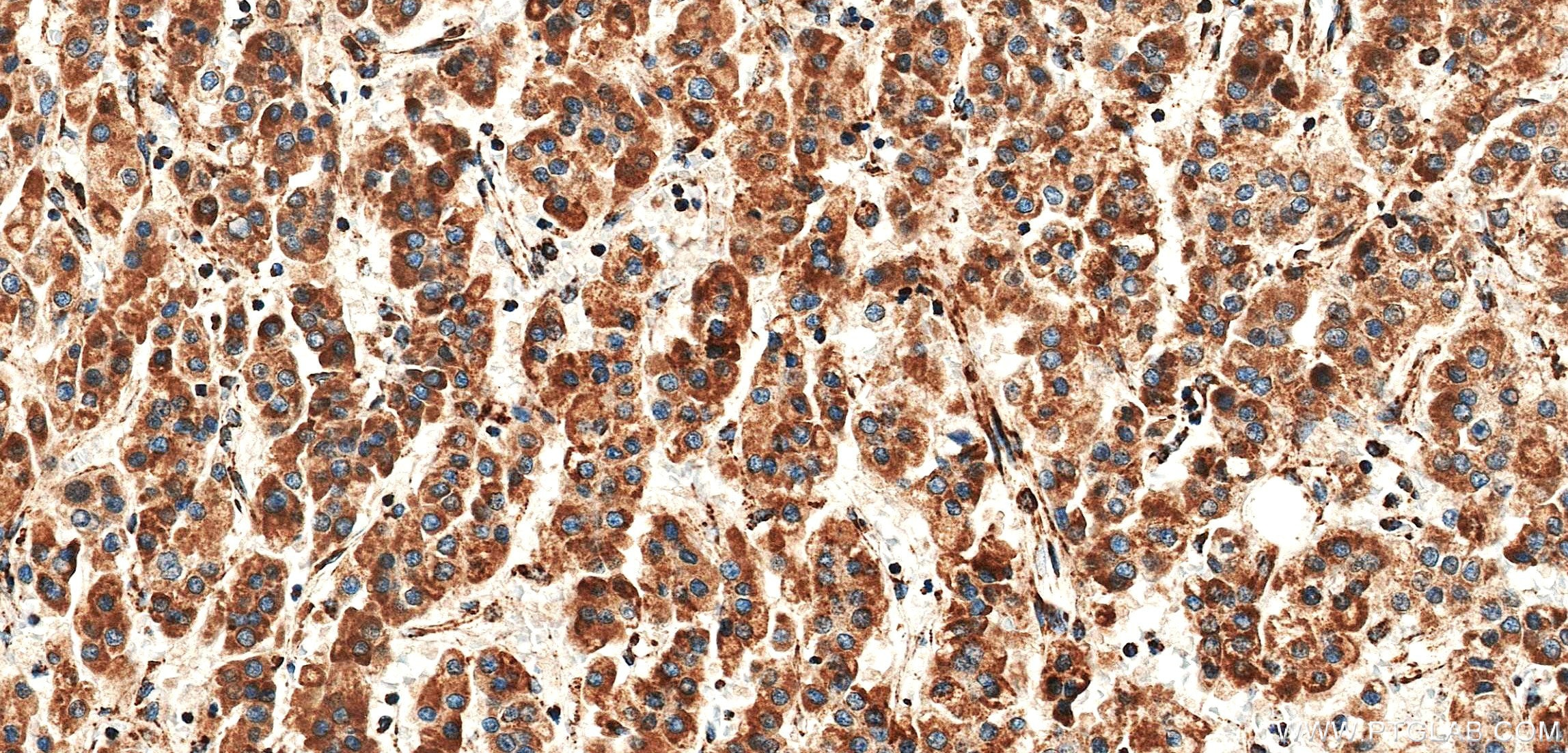 IHC staining of Human Hepatocellular cancer using 86635-1-RR Immunohistochemistry (IHC) staining of Human Hepatocellular cancer using SLC25A24 Recombinant monoclonal antibody (86635-1-RR)