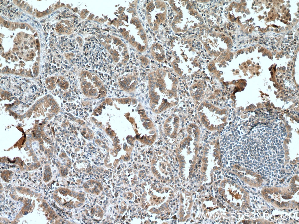 Immunohistochemistry (IHC) staining of human lung cancer tissue using SLC25A3 Polyclonal antibody (10420-1-AP)