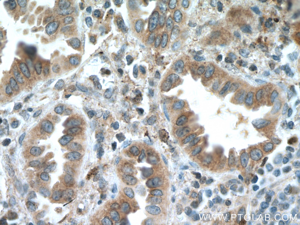IHC staining of human lung cancer using 10420-1-AP
