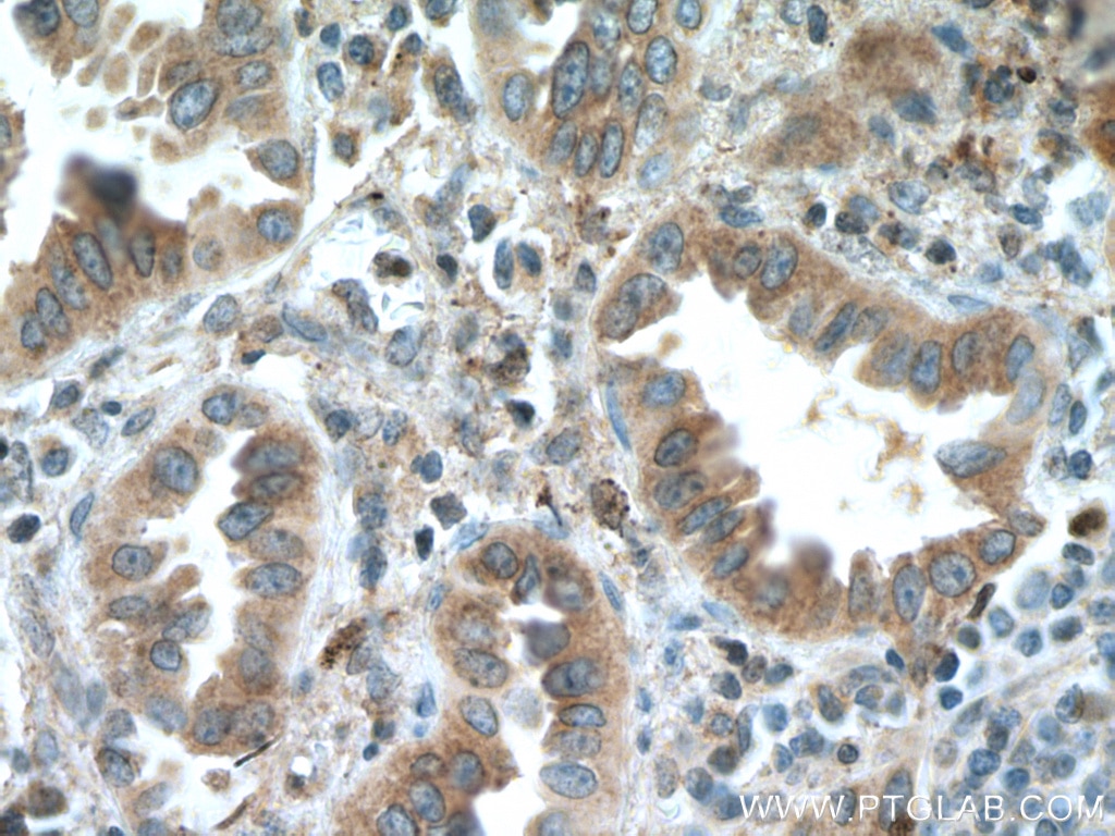 Immunohistochemistry (IHC) staining of human lung cancer tissue using SLC25A3 Polyclonal antibody (10420-1-AP)