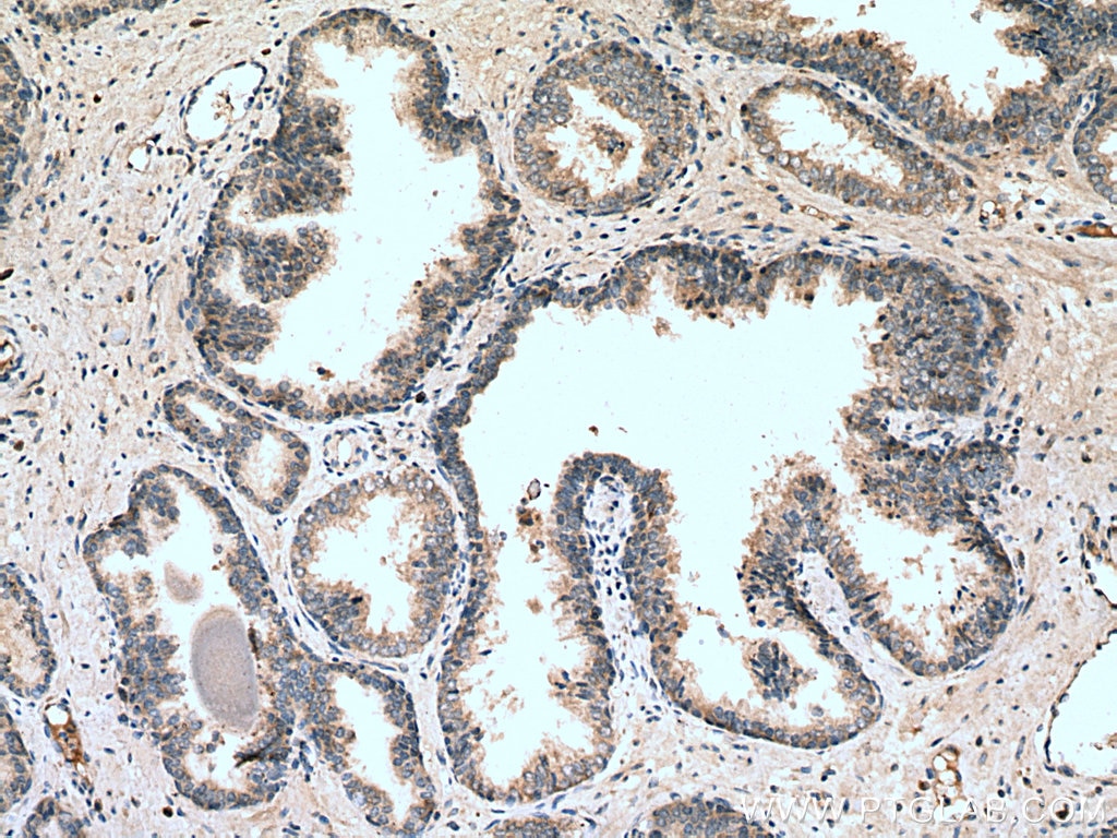 Immunohistochemistry (IHC) staining of human prostate cancer tissue using SLC25A32 Polyclonal antibody (13080-1-AP)