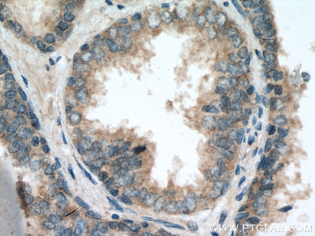 Immunohistochemistry (IHC) staining of human prostate cancer tissue using SLC25A32 Polyclonal antibody (13080-1-AP)