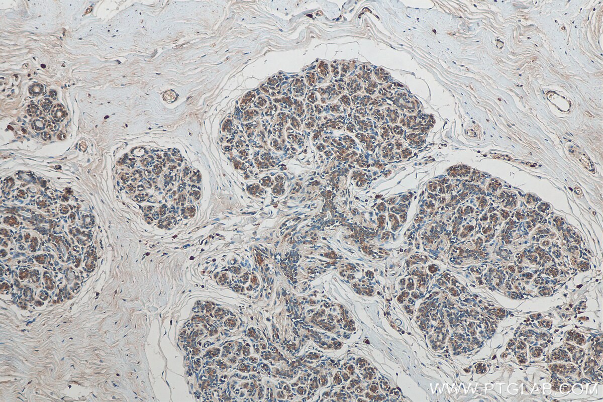 Immunohistochemistry (IHC) staining of human breast cancer tissue using SLC25A36 Monoclonal antibody (67896-1-Ig)