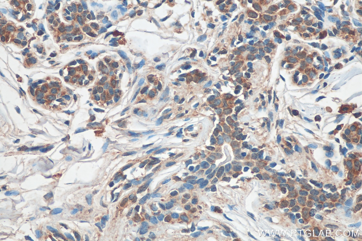 Immunohistochemistry (IHC) staining of human breast cancer tissue using SLC25A36 Monoclonal antibody (67896-1-Ig)