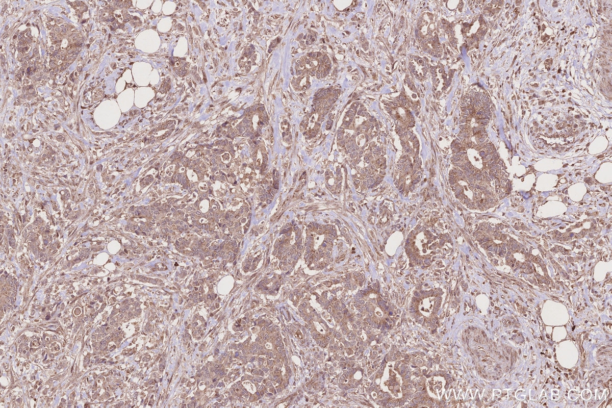 Immunohistochemistry (IHC) staining of human rectal cancer tissue using SLC25A46 Polyclonal antibody (12277-1-AP)