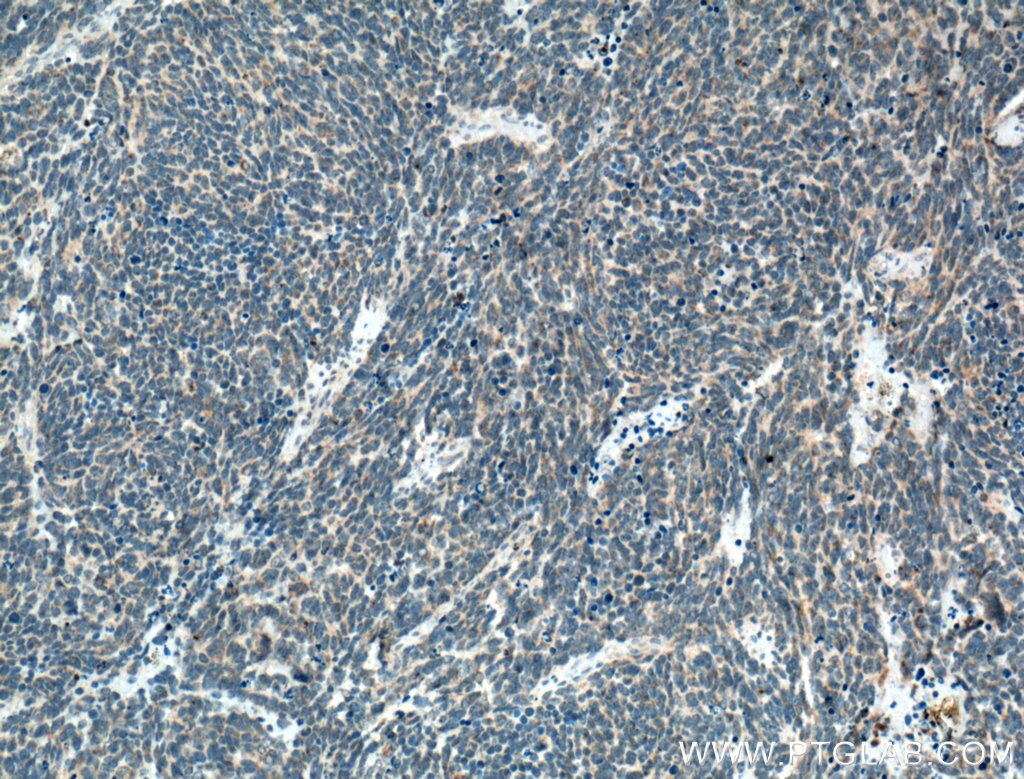 Immunohistochemistry (IHC) staining of human medulloblastoma tissue using SLC25A46 Polyclonal antibody (27869-1-AP)