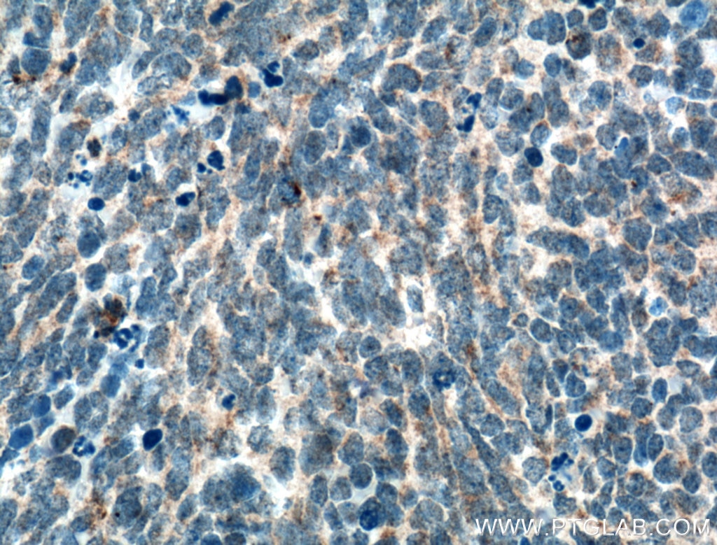 Immunohistochemistry (IHC) staining of human medulloblastoma tissue using SLC25A46 Polyclonal antibody (27869-1-AP)