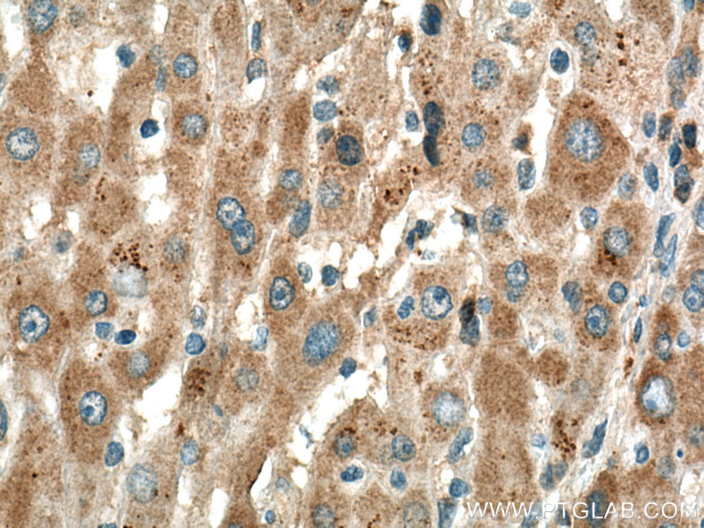 Immunohistochemistry (IHC) staining of human liver cancer tissue using SLC25A47 Polyclonal antibody (26292-1-AP)