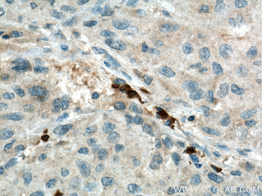 Immunohistochemistry (IHC) staining of human liver cancer tissue using SLC25A47 Polyclonal antibody (26292-1-AP)