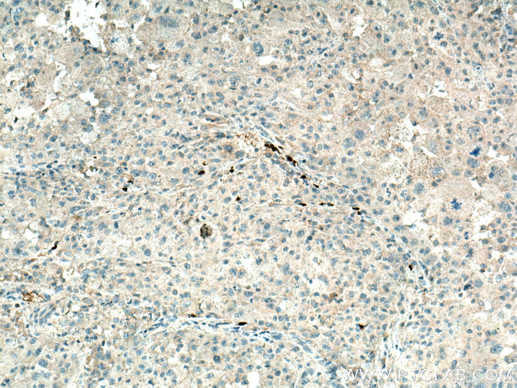 Immunohistochemistry (IHC) staining of human liver cancer tissue using SLC25A47 Polyclonal antibody (26292-1-AP)