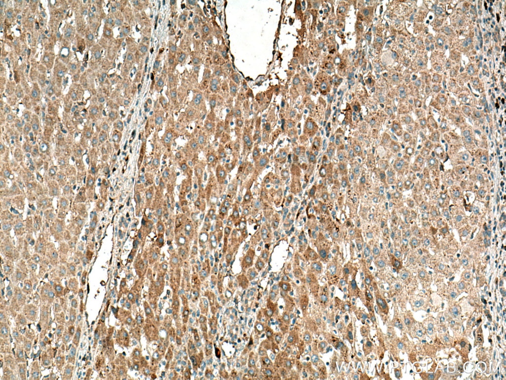 Immunohistochemistry (IHC) staining of human liver cancer tissue using SLC25A47 Polyclonal antibody (26292-1-AP)