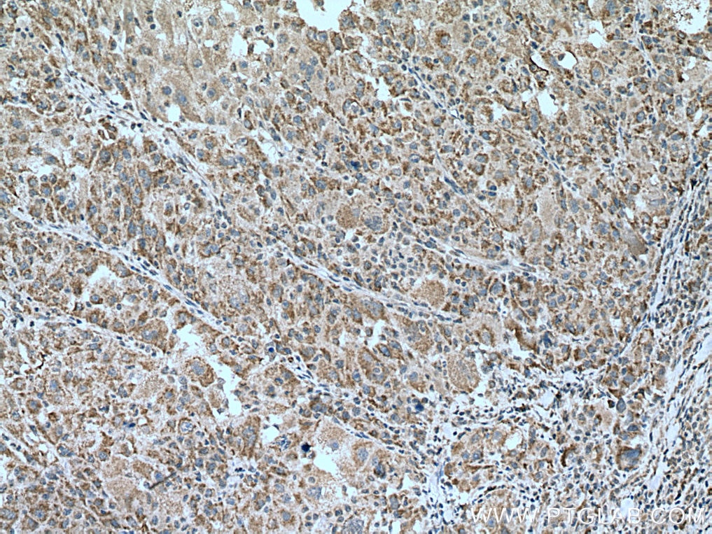 Immunohistochemistry (IHC) staining of human liver cancer tissue using ANT1/2 Polyclonal antibody (17796-1-AP)