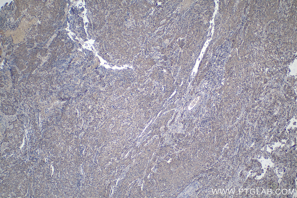 IHC staining of human cervical cancer using 17796-1-AP