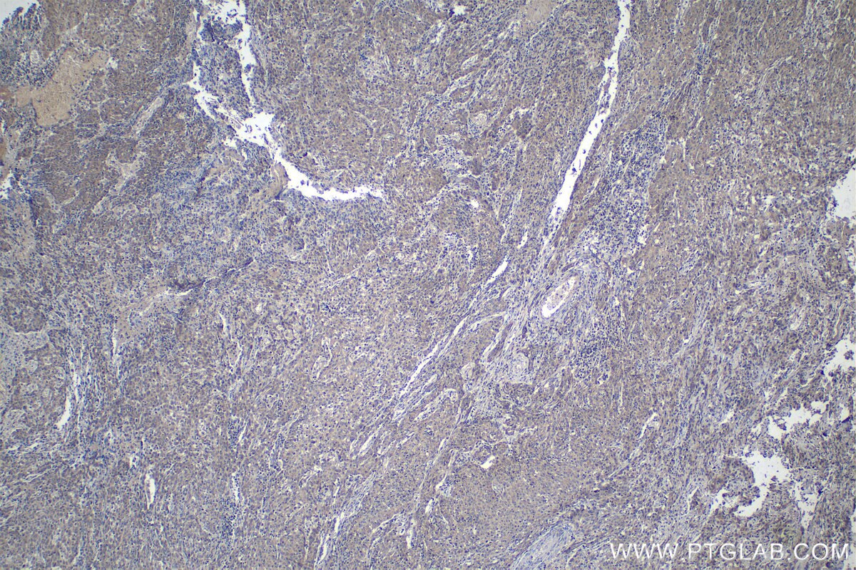 Immunohistochemistry (IHC) staining of human cervical cancer tissue using ANT1/2 Polyclonal antibody (17796-1-AP)