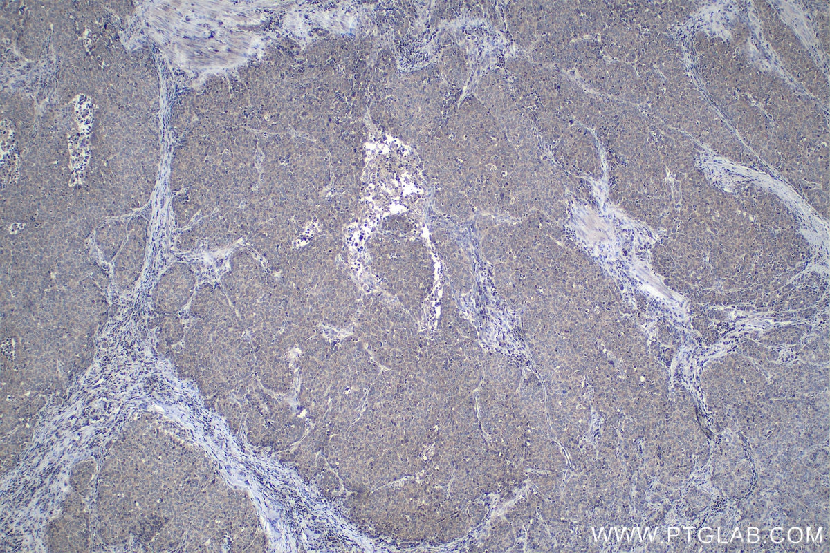 Immunohistochemistry (IHC) staining of human stomach cancer tissue using ANT1/2 Polyclonal antibody (17796-1-AP)