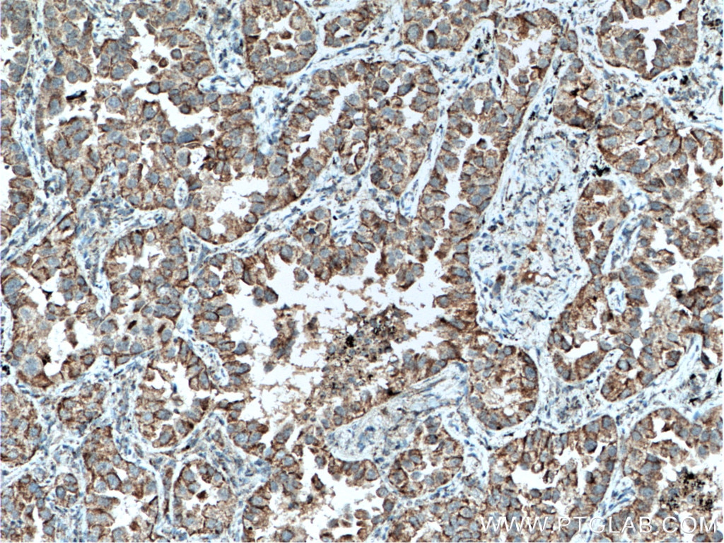 Immunohistochemistry (IHC) staining of human lung cancer tissue using SLC25A6 Polyclonal antibody (51031-1-AP)