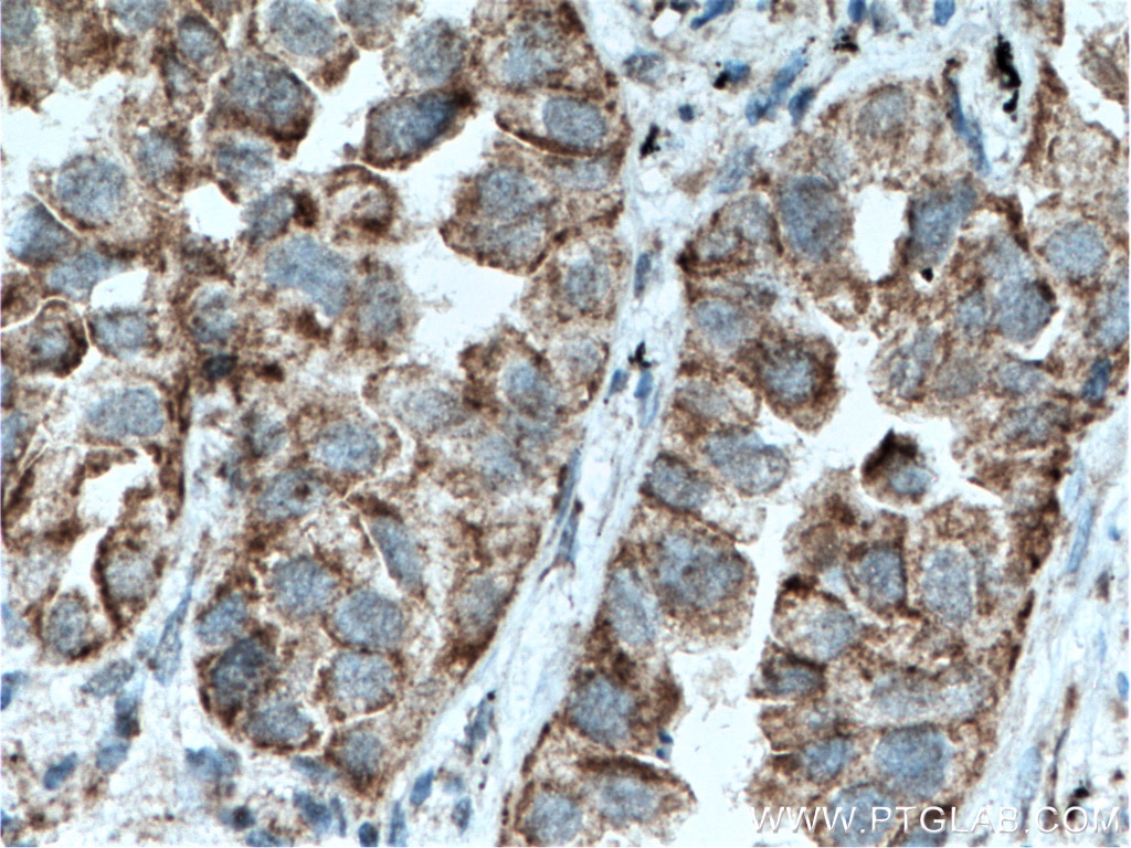 Immunohistochemistry (IHC) staining of human lung cancer tissue using SLC25A6 Polyclonal antibody (51031-1-AP)