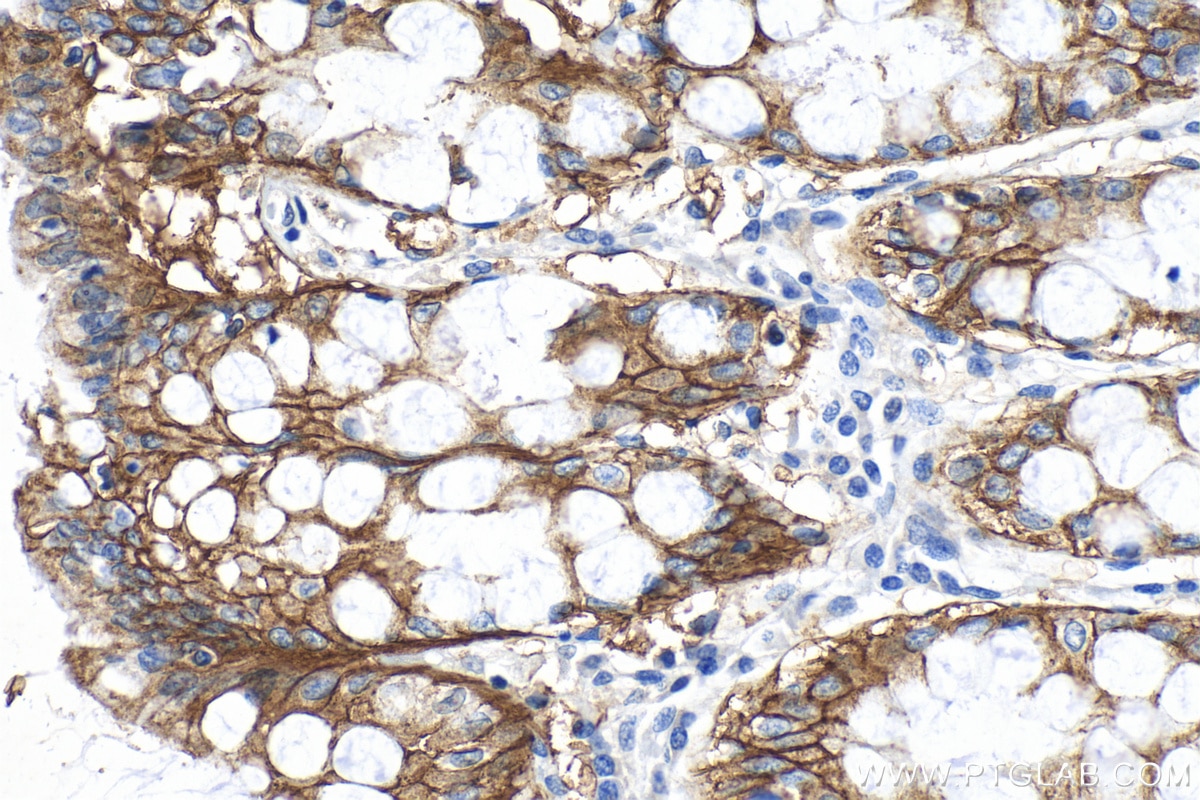 Immunohistochemistry (IHC) staining of human colon tissue using SLC26A2 Polyclonal antibody (27759-1-AP)