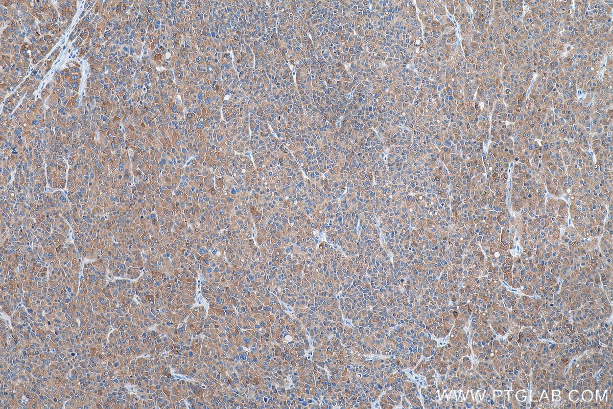 Immunohistochemistry (IHC) staining of human liver cancer tissue using FATP2 Polyclonal antibody (14048-1-AP)