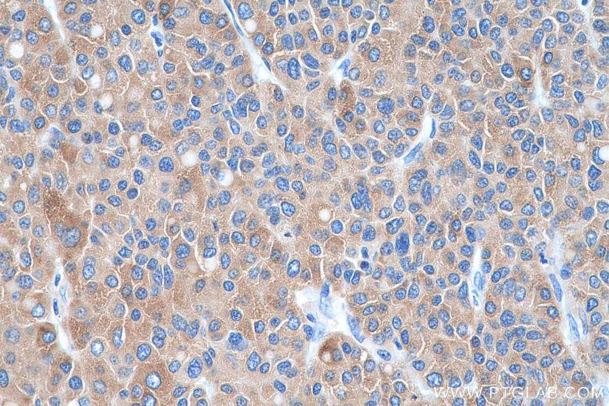 Immunohistochemistry (IHC) staining of human liver cancer tissue using FATP2 Polyclonal antibody (14048-1-AP)